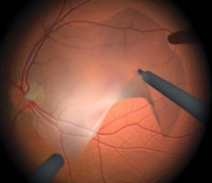 ERM (Epiretinal Membrane) Surgery