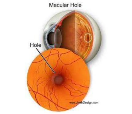 Macular HolebrSurgery