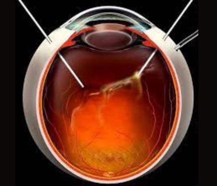 PPV (Pars Plana Vitrectomy) for Vitreous Hemorrhage