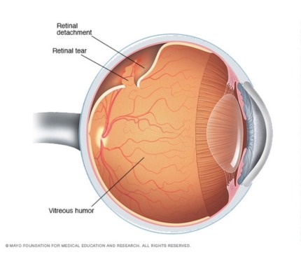 PPV for Fresh RD (Retinal Detachment)