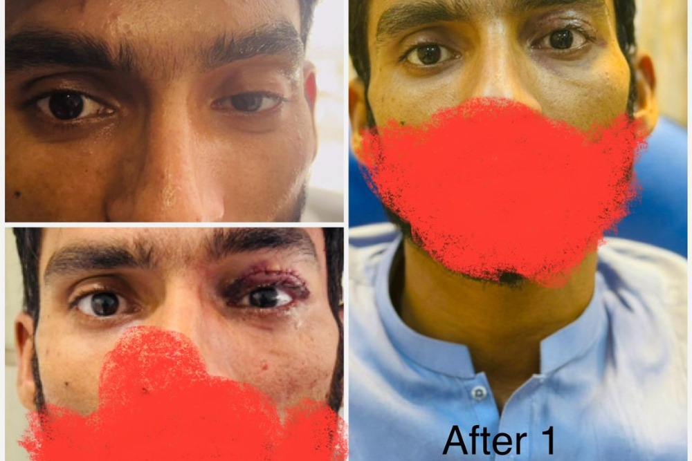 Ptosis Surgery